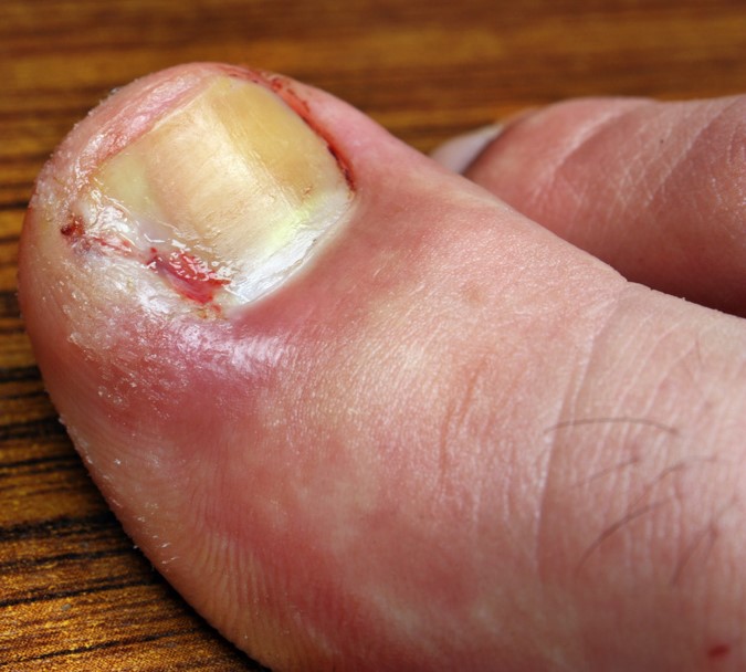 Infection In The Toe Nail Podiatry Care